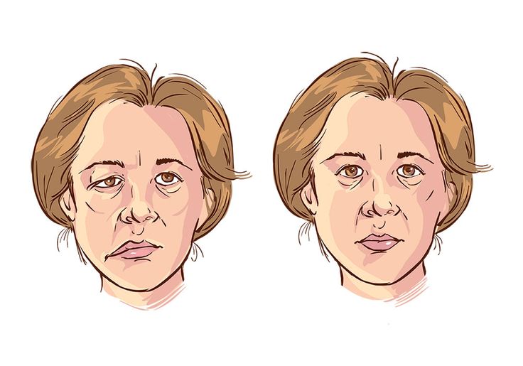 Bell Palsy Face